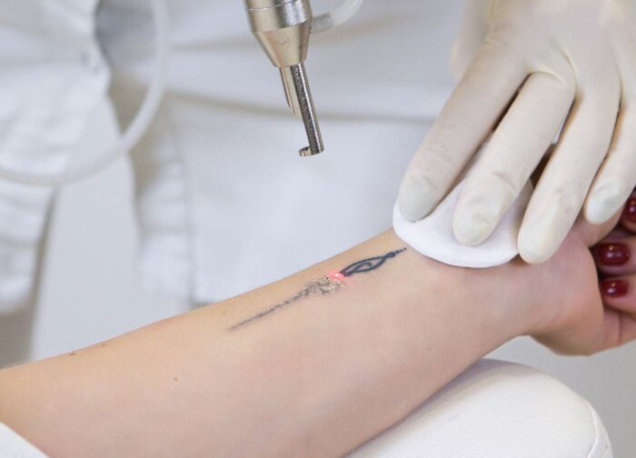 All Your Tattoo Removal Questions, Answered | RealSelf All Your Tattoo Removal Questions, Answered | RealSelf