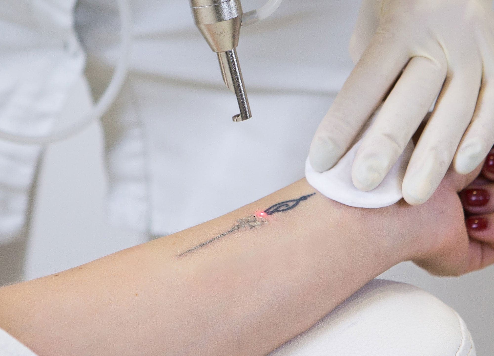 Laser Tattoo Removal for Different Skin Types | Pulse Light Clinic London