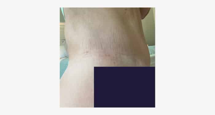 What Real Tummy Tuck Scars Look Like On 12 Patients