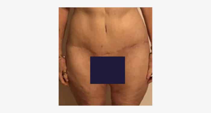 Tummy Tuck Scars Over Time with Pictures and posted Jan 26, 2024