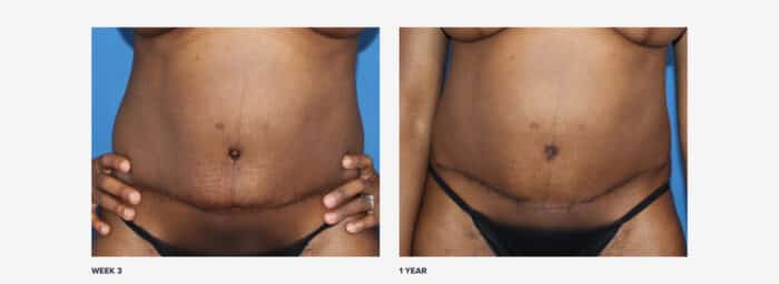 What Real Tummy Tuck Scars Look Like On 12 Patients | RealSelf News