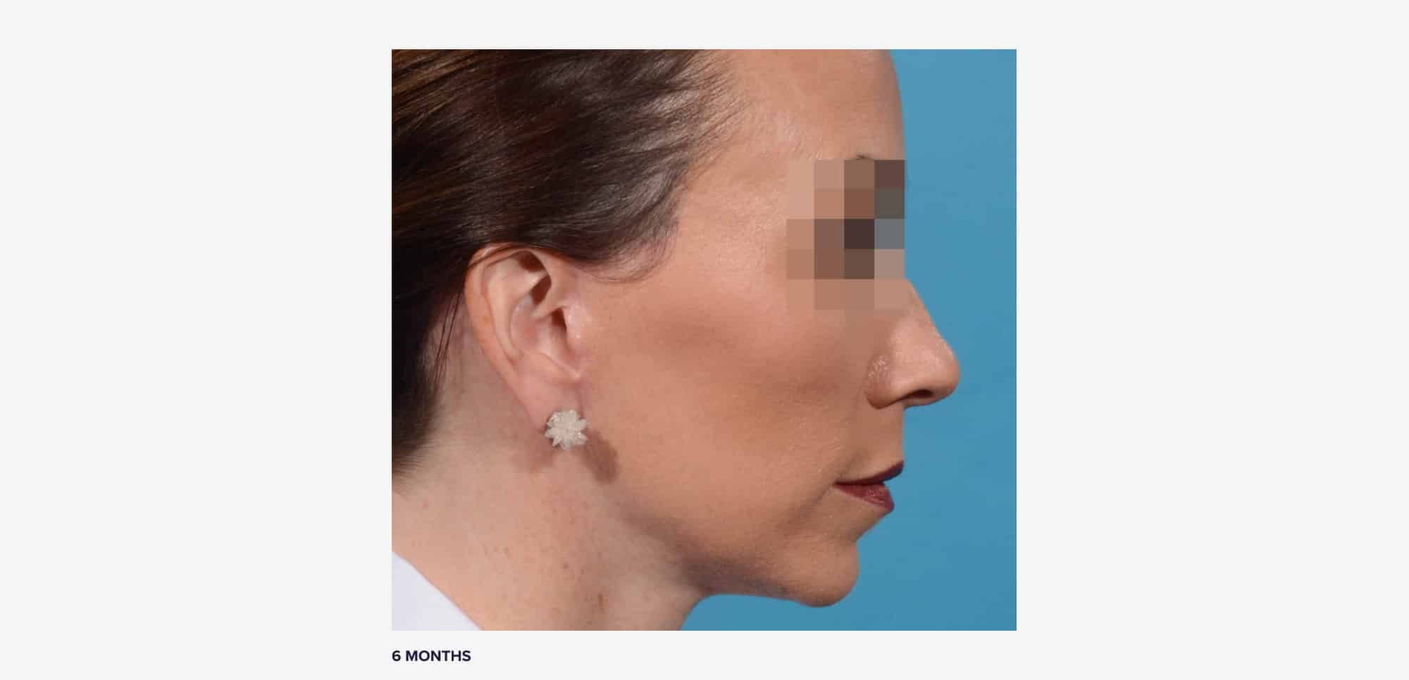 What Real Facelift Scars Look Like on 11 Patients RealSelf News