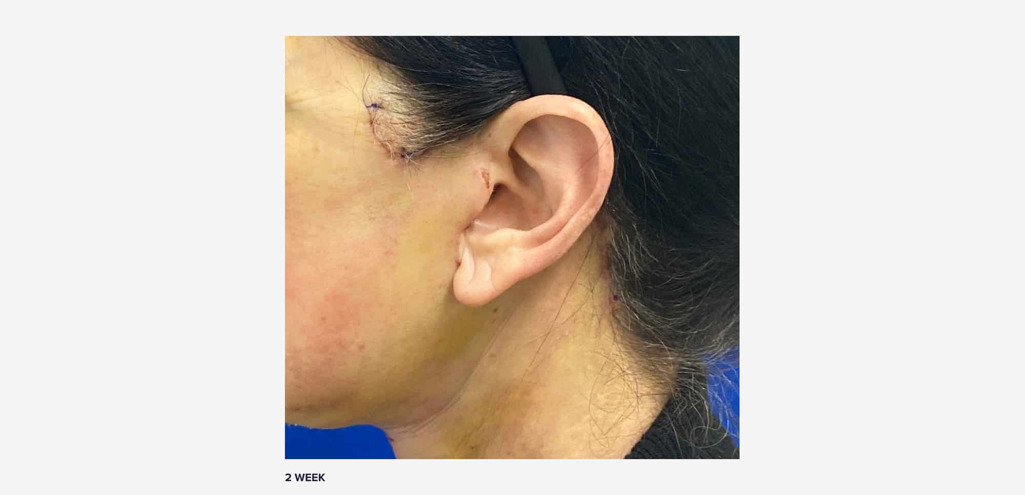 What Real Facelift Scars Look Like on 11 Patients RealSelf News