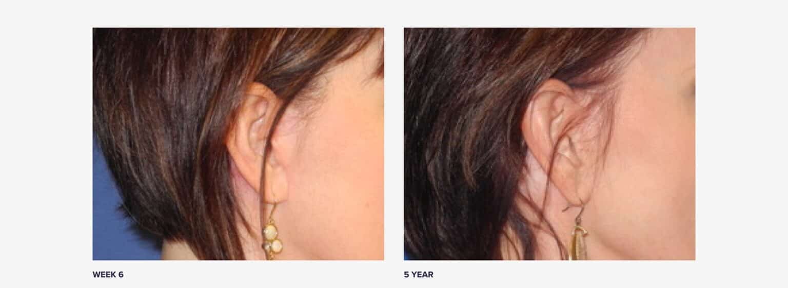What Real Facelift Scars Look Like on 11 Patients RealSelf News