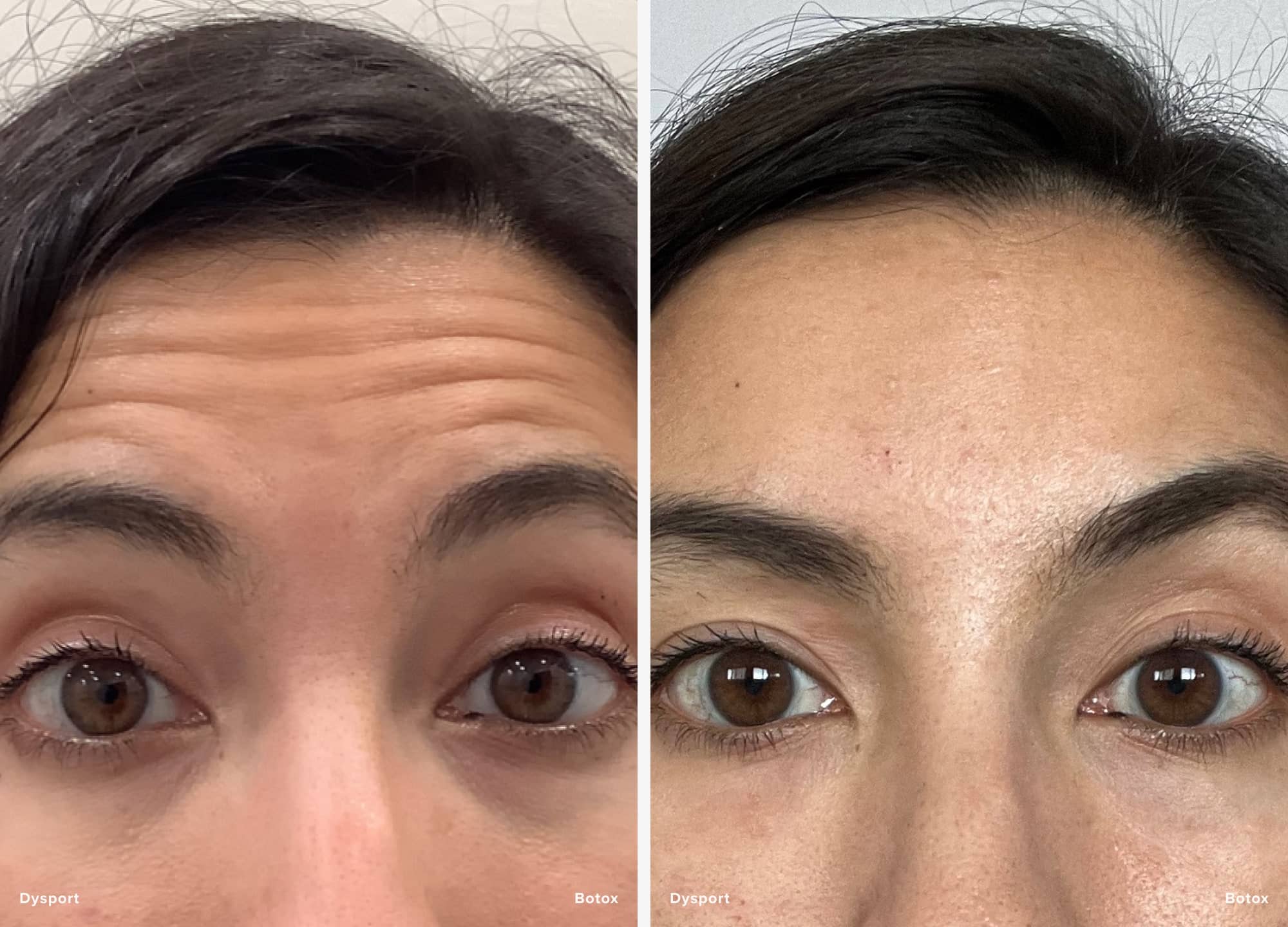 Curious about Botox vs. Dysport? One patient injected half her forehead with Botox and the other half with Dysport. See her results.