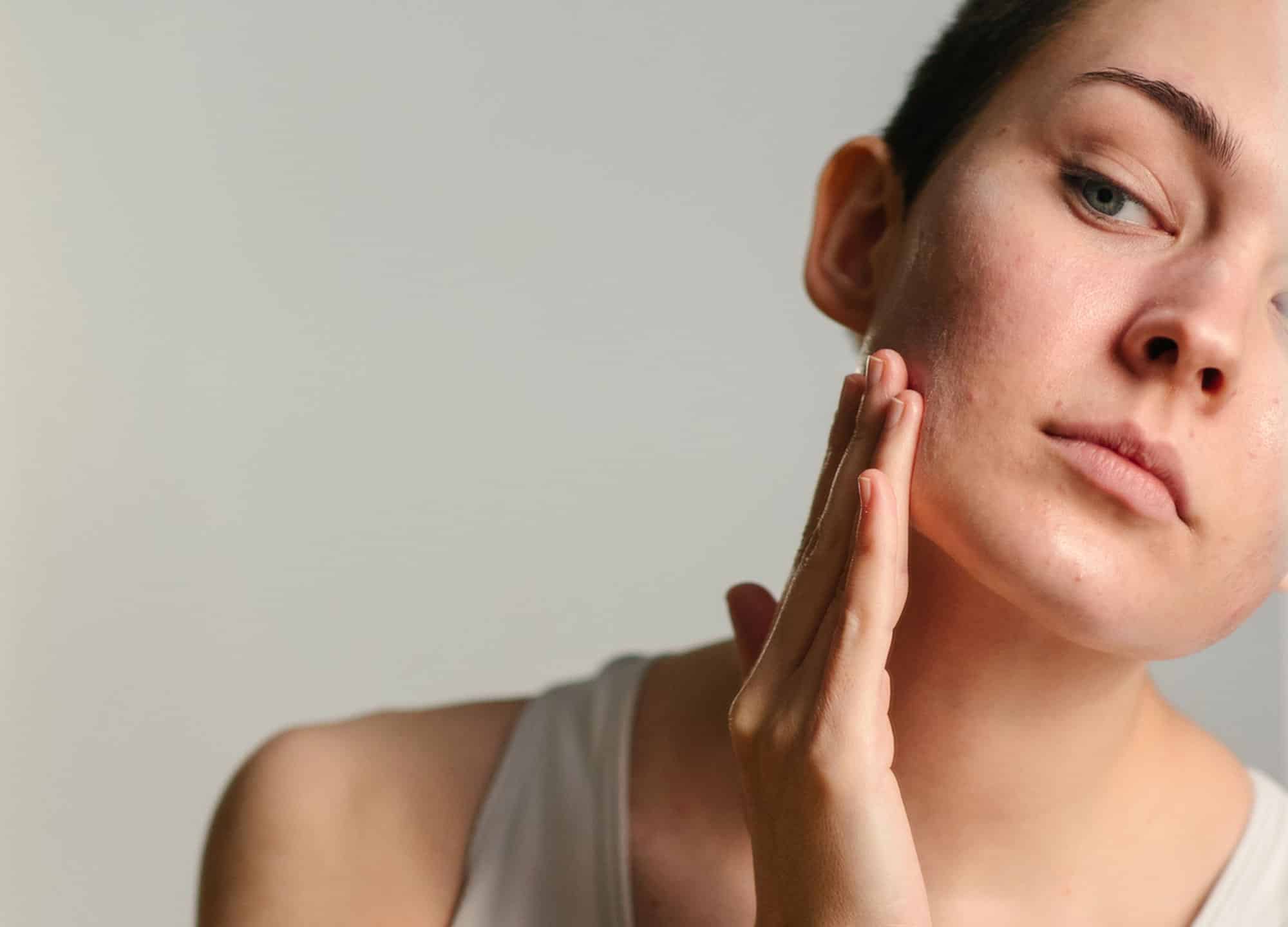 Winlevi is a prescription-only acne cream that works in an entirely different manner from that of any other topicals. Here's what derms think.
