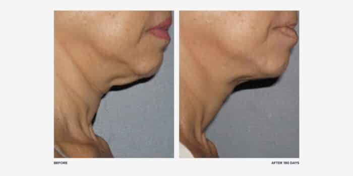 Before and after Ultherapy on neck, side view
