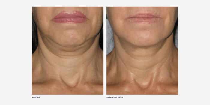 Before and after Ultherapy on neck, front view