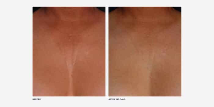 Before and after chest Ultherapy results