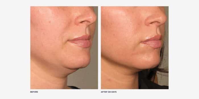 Before and after photos of Ultherapy results on the chin