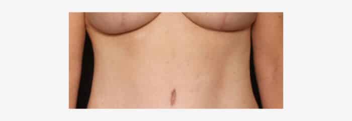 Breast lift scars at 10 weeks post op