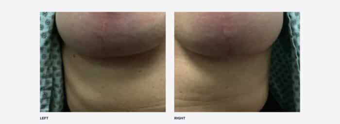 Breast lift scars at 9 weeks post op