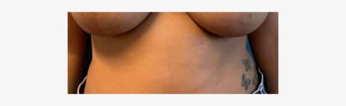 Breast lift scars at 12 weeks post op