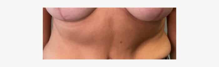Breast lift scars at 8 weeks post op