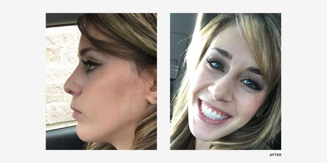 I Got Double Jaw Surgery. See My Before & After Photos RealSelf News