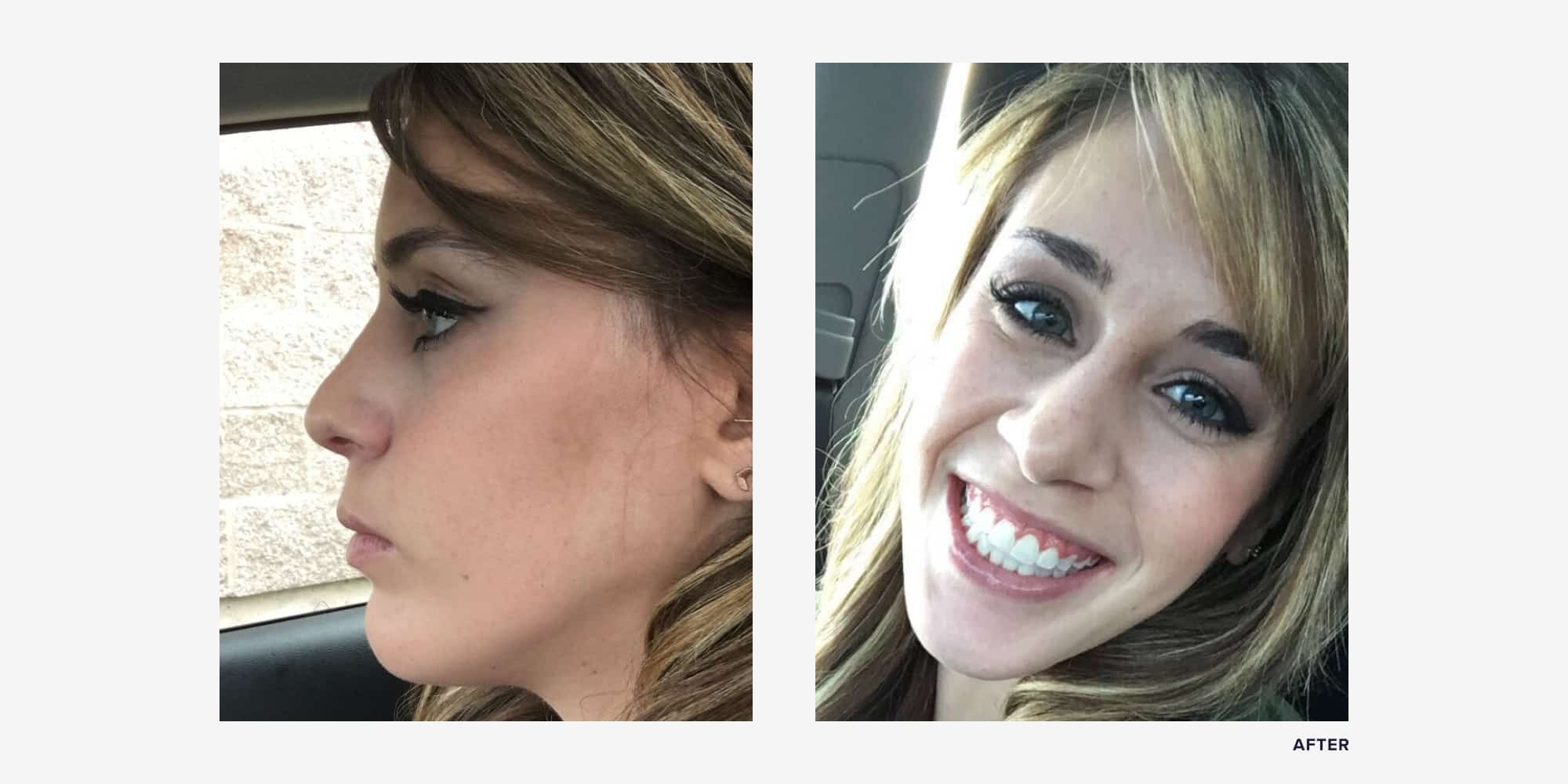 I Got Double Jaw Surgery. See My Before & After Photos RealSelf News