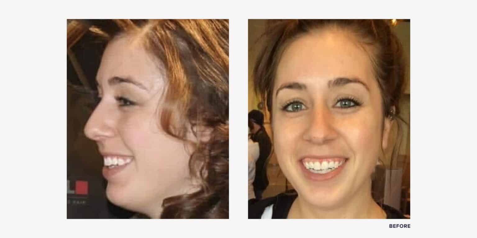 I Got Double Jaw Surgery. See My Before & After Photos RealSelf News