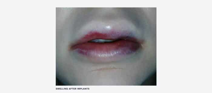 Swelling and bruising after lip implants image