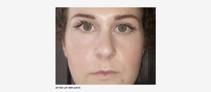 After lip implants image