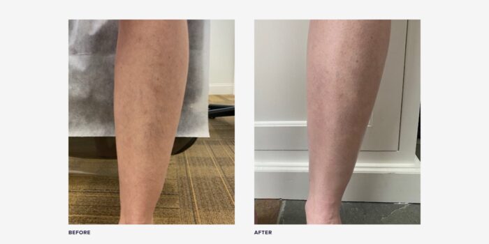 Sclerotherapy results before and after