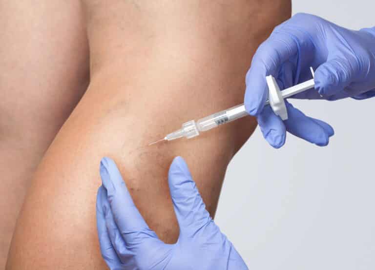 Learn how sclerotherapy treats spider veins, what treatment is like, its risks, and if I thought my results were worth it.
