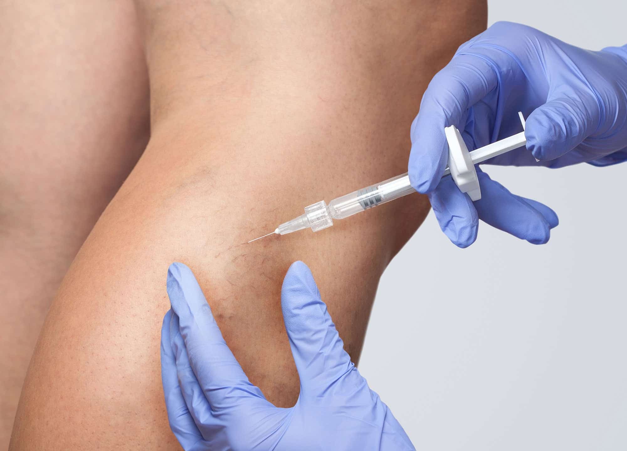 Learn how sclerotherapy treats spider veins, what treatment is like, its risks, and if I thought my results were worth it.