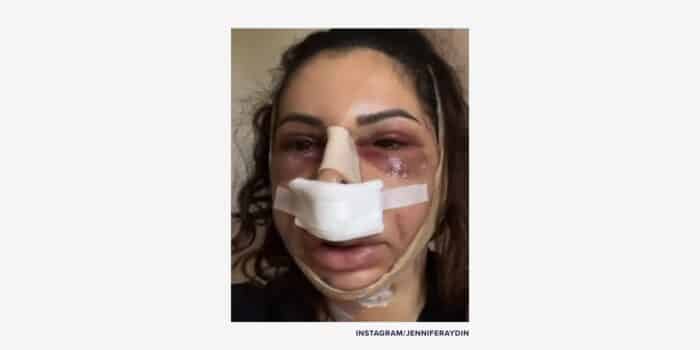 Aydin bruising
