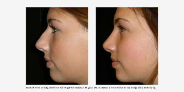 Rhinoplasty before and after photo