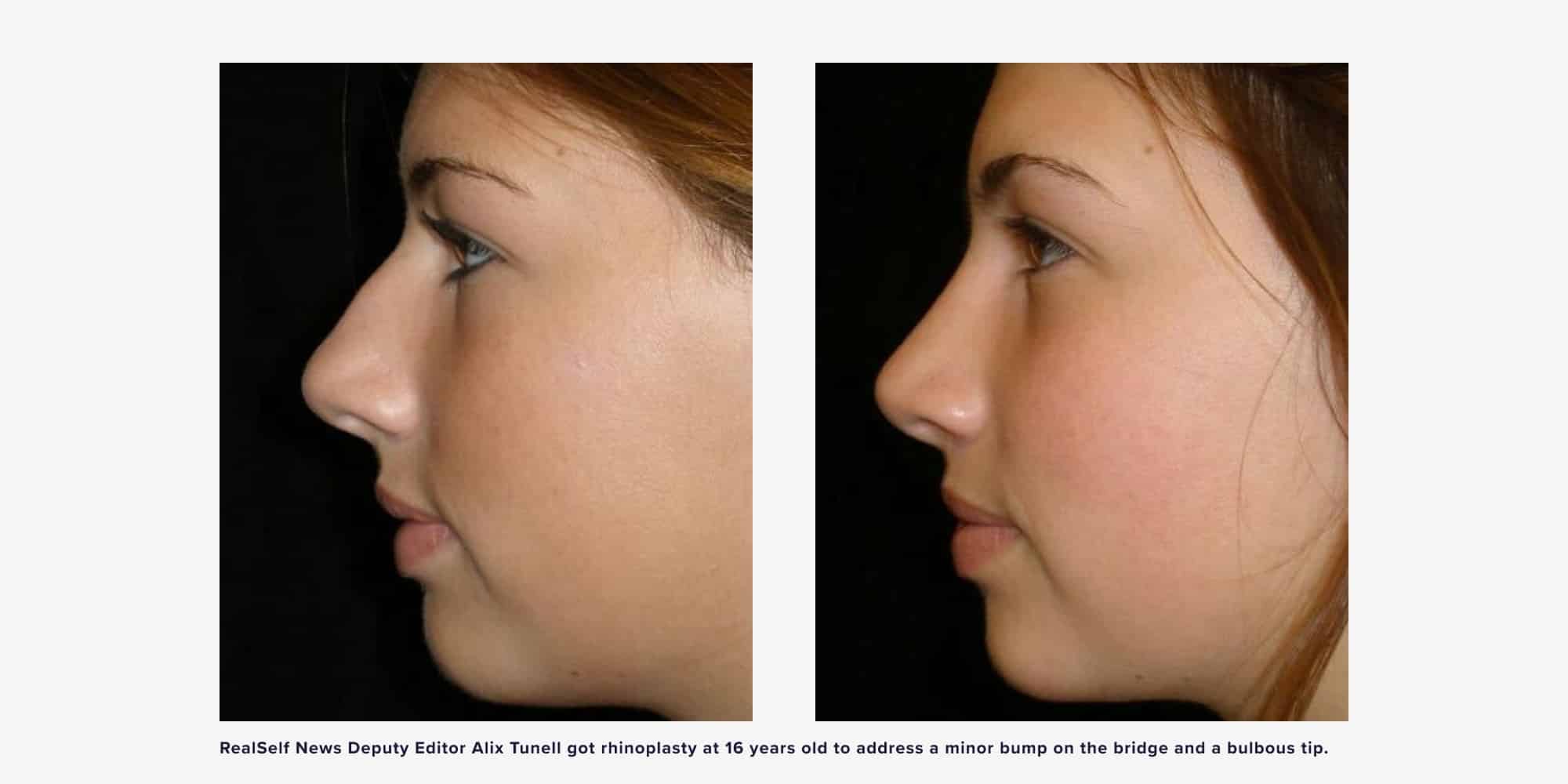 How Young Is Too Young for Rhinoplasty? | RealSelf News