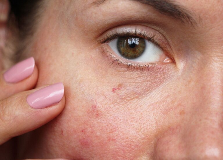 Close up of woman's face with redness