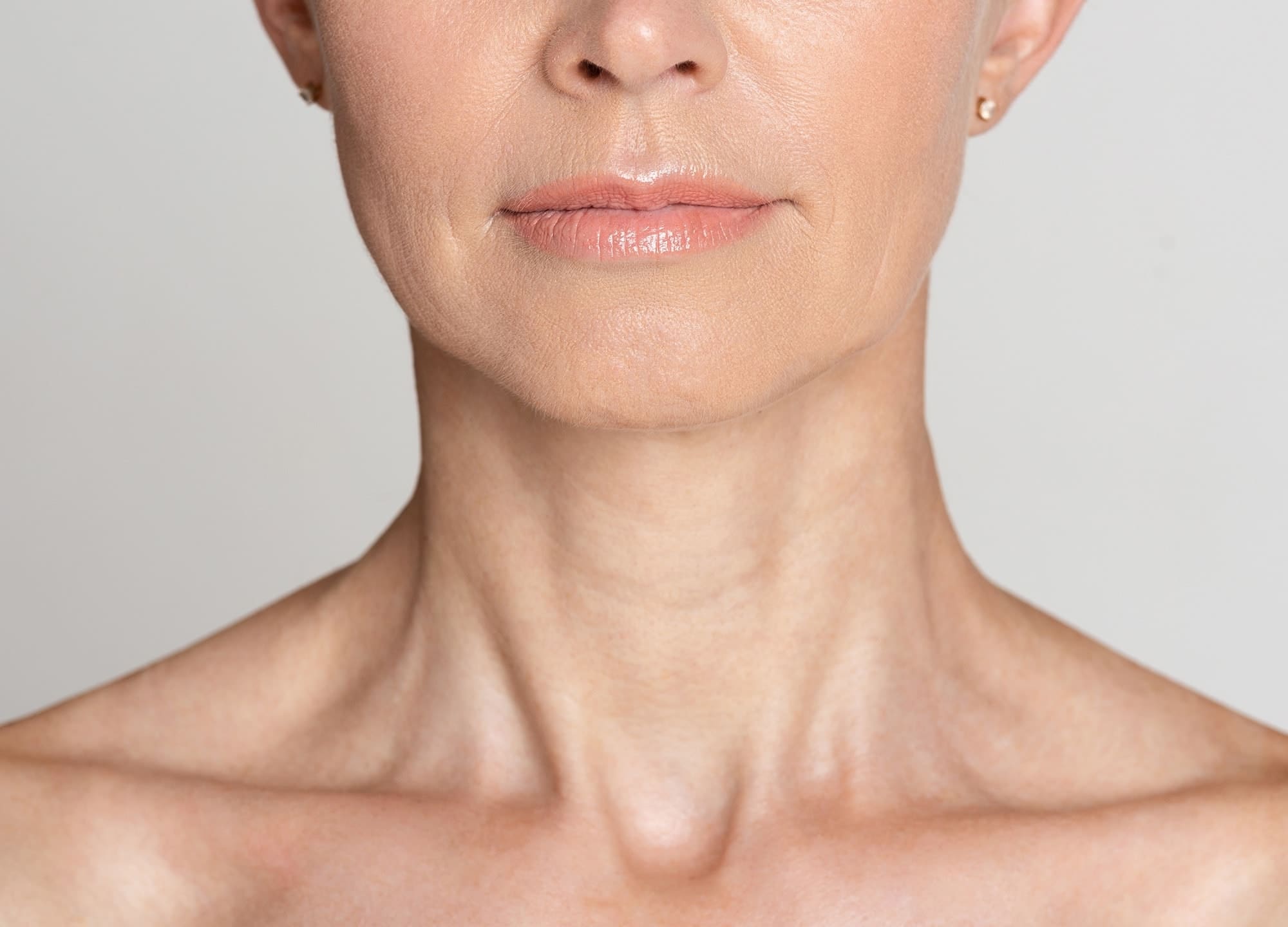 Close up of woman's neck with neck bands which can be treated by neck Botox