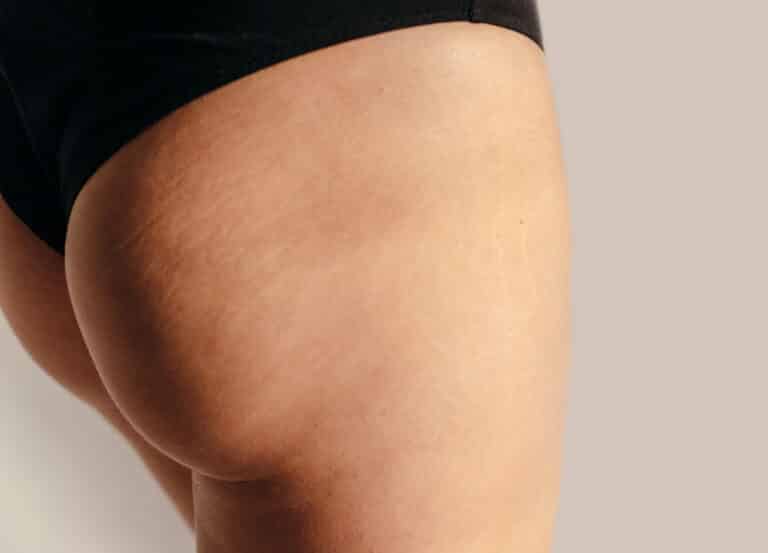 Close up view of woman's butt after Brazilian butt lift