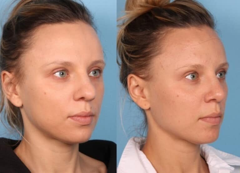 Rhinoplasty and septoplasty before and after