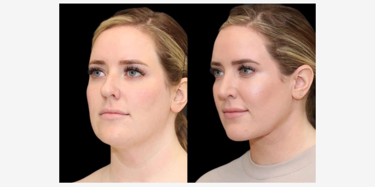 4 Signs of Good Buccal Fat Removal Results RealSelf News