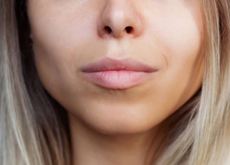 Woman with sharp cheekbones and jawline after buccal fat removal