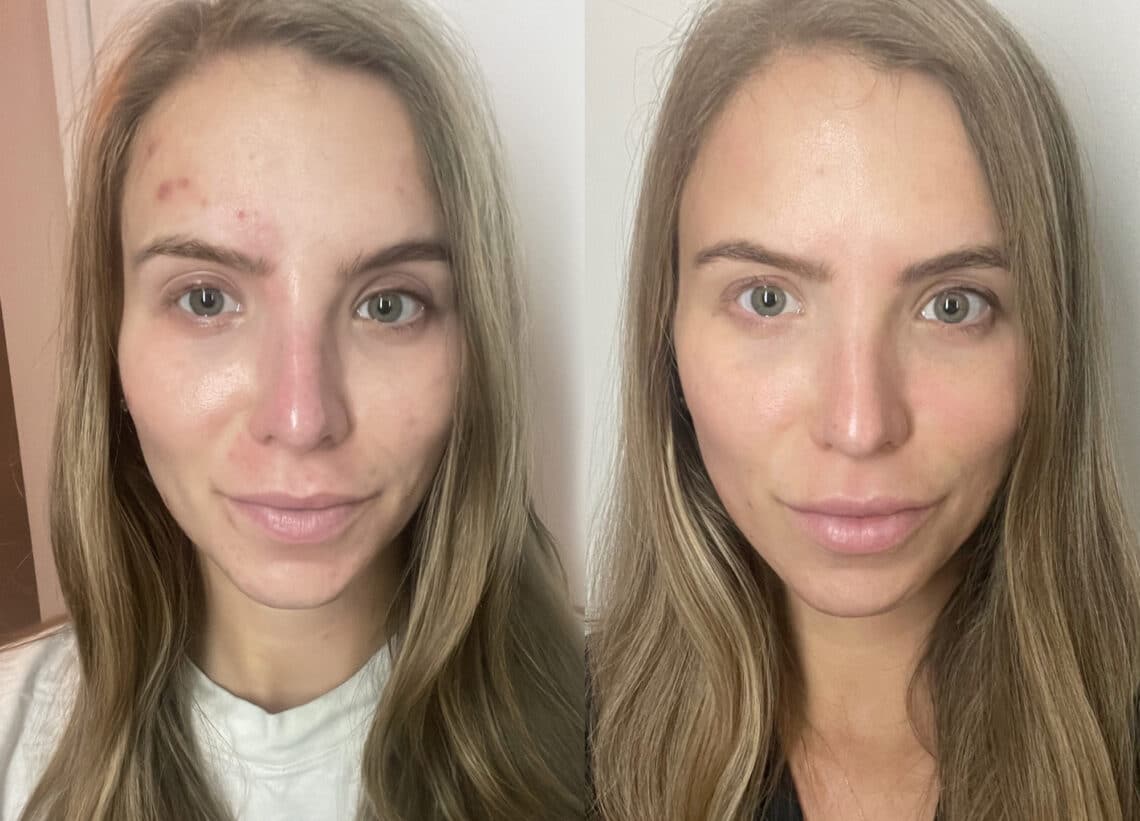 AviClear Laser for Acne My Before and After Results RealSelf News