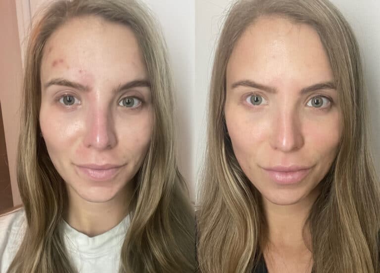 Before and after Aviclear laser treatment