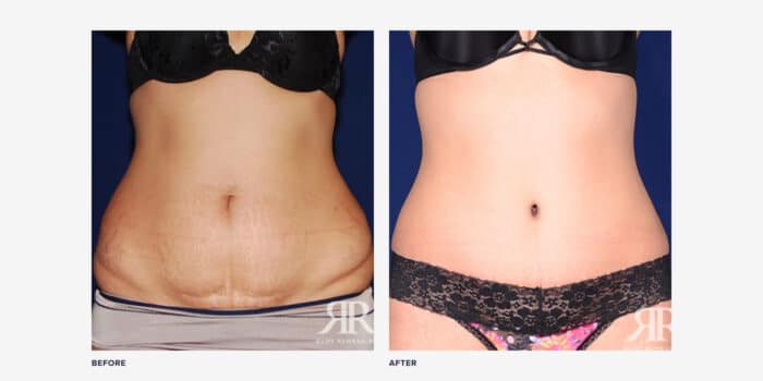 Is It a Good Time for A Tummy Tuck? - Dr. York Yates Plastic Surgery