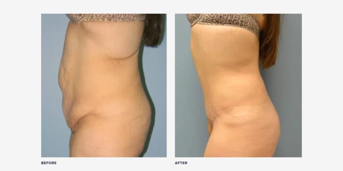 Best Tummy Tuck in Seattle