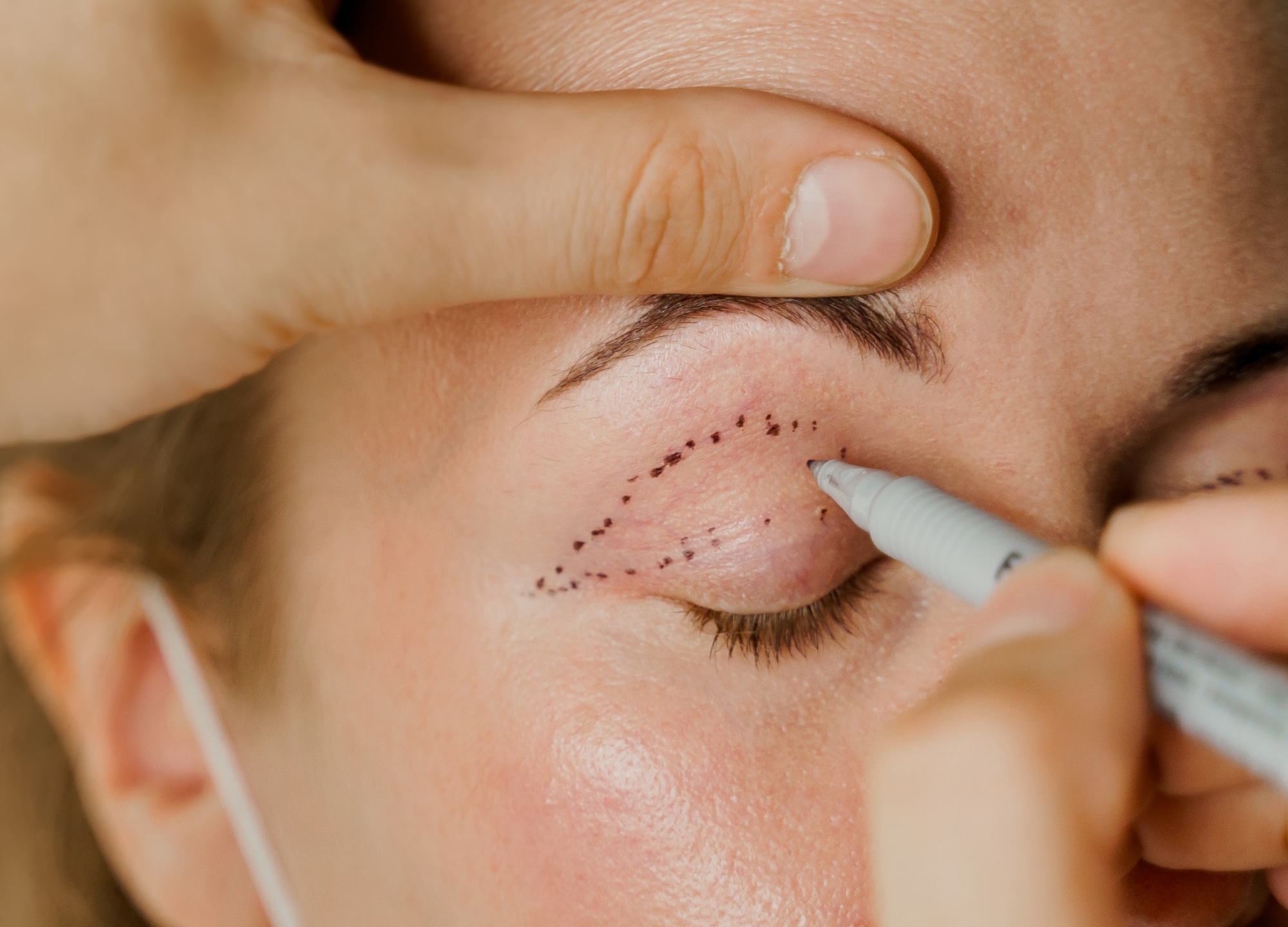 Eyelid surgery risks