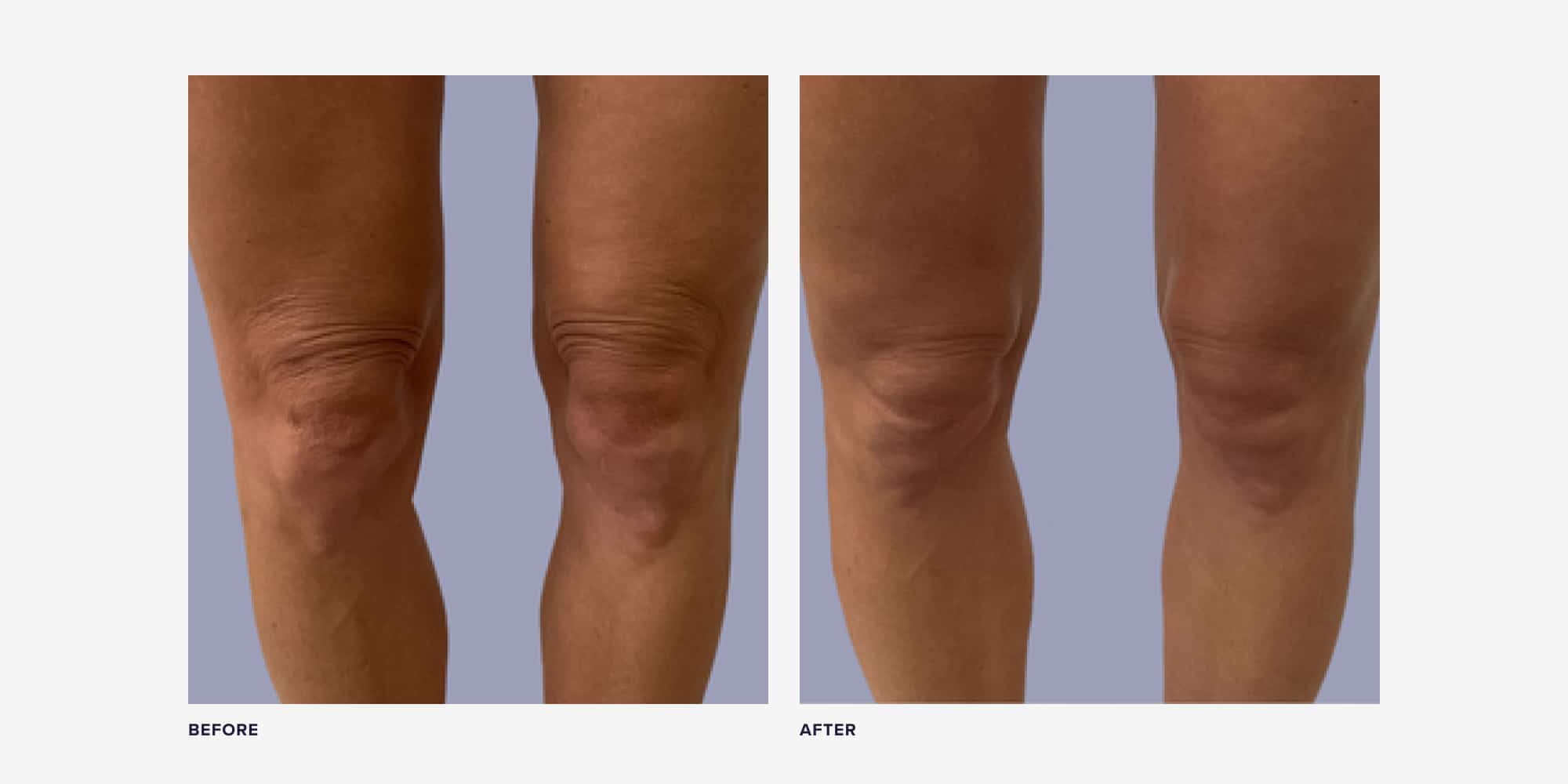 The Best Morpheus8 Before And After Photos RealSelf News the-best-morpheus8-before-and-after-photos-realself-news