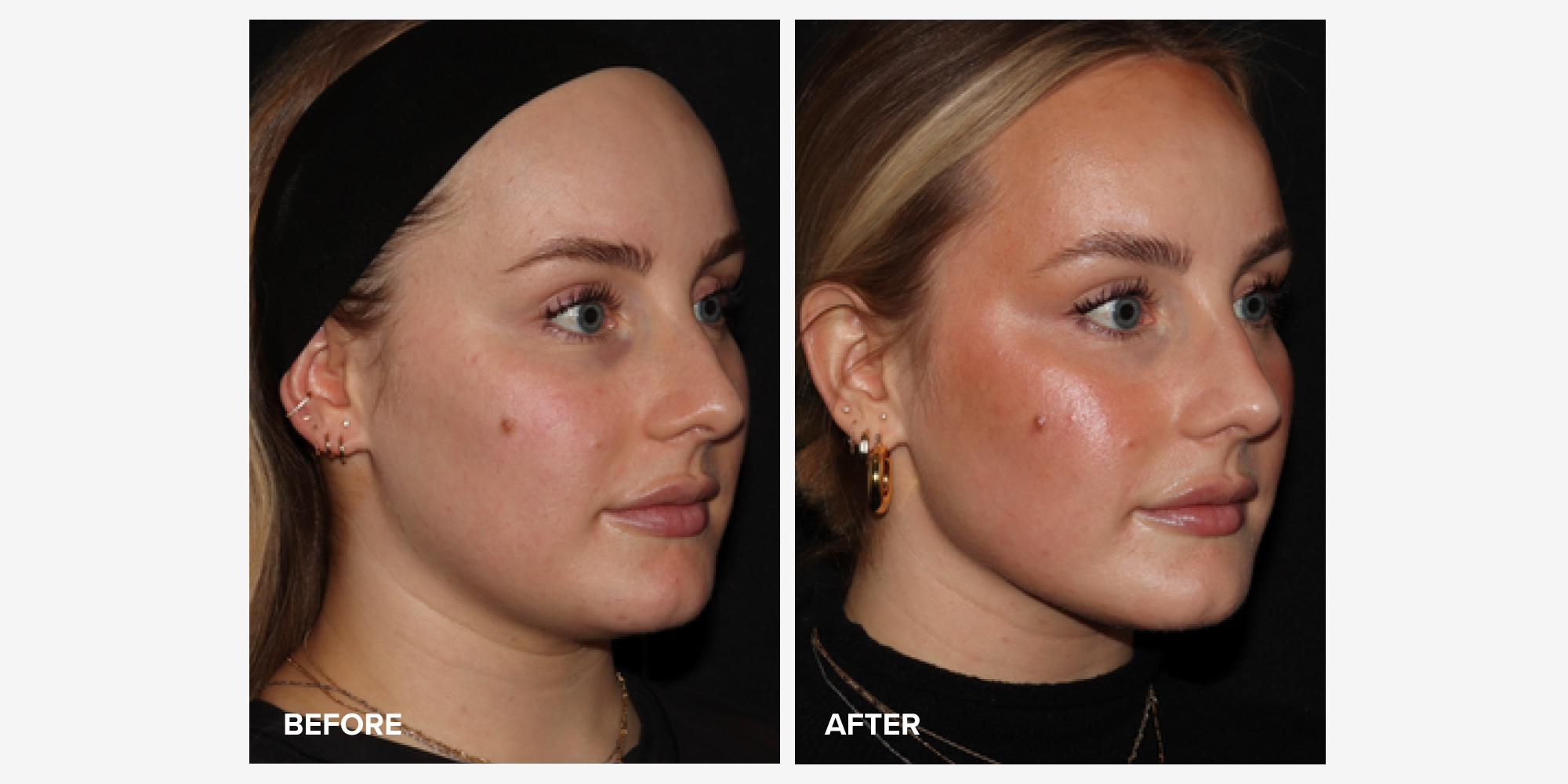 Emface Before and After Photos: Are the Results Worth It? RealSelf News