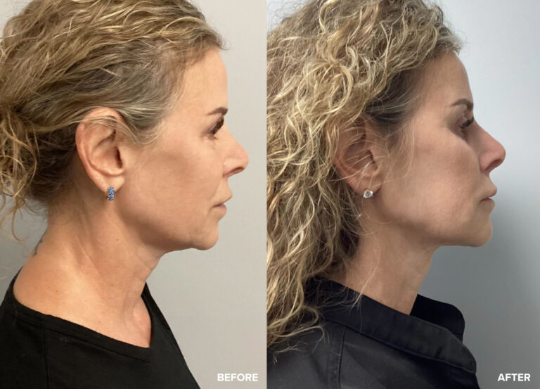 Before and after photo of woman's Facetite results