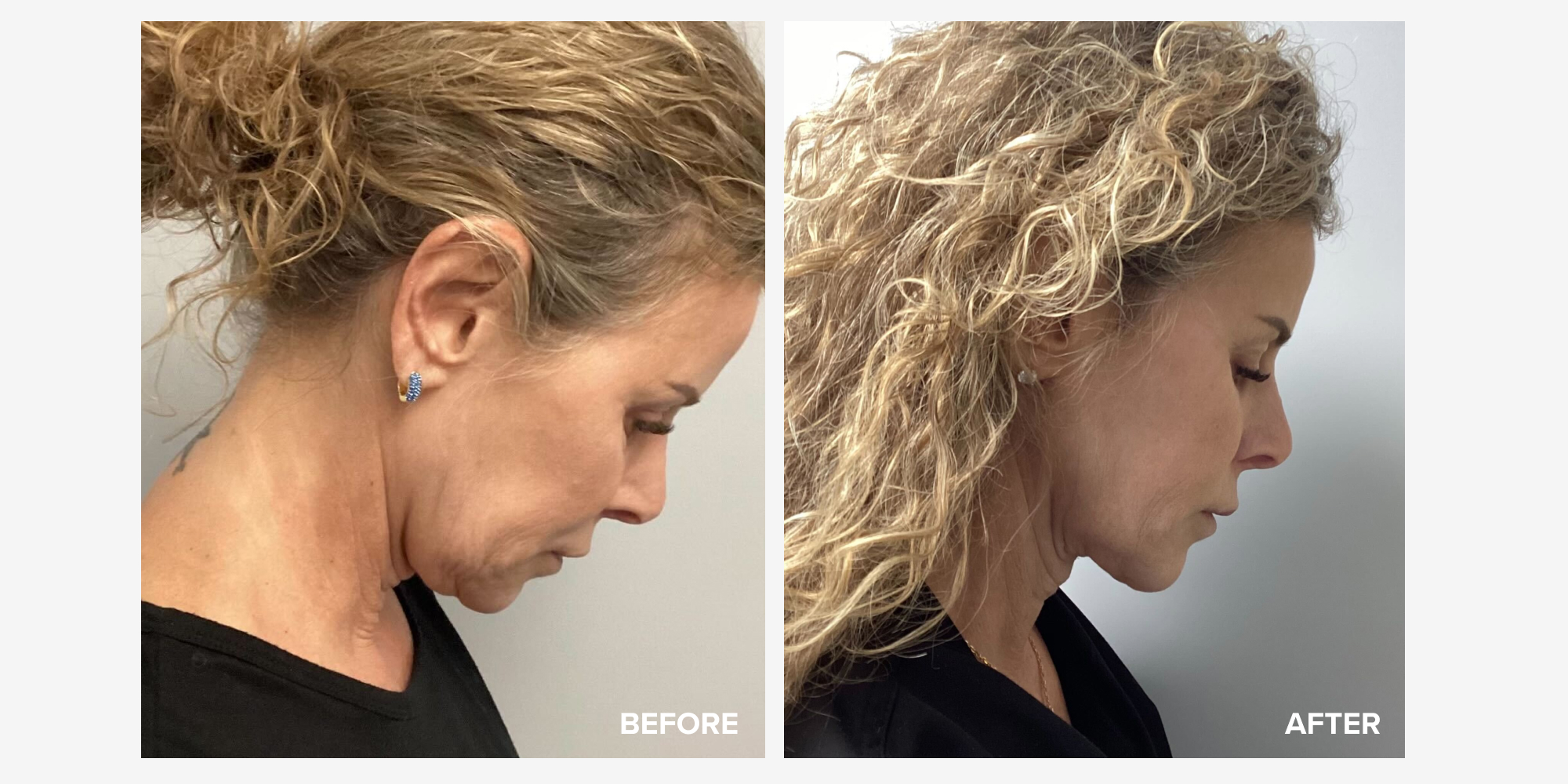 My FaceTite Review and Before and After Photos RealSelf News