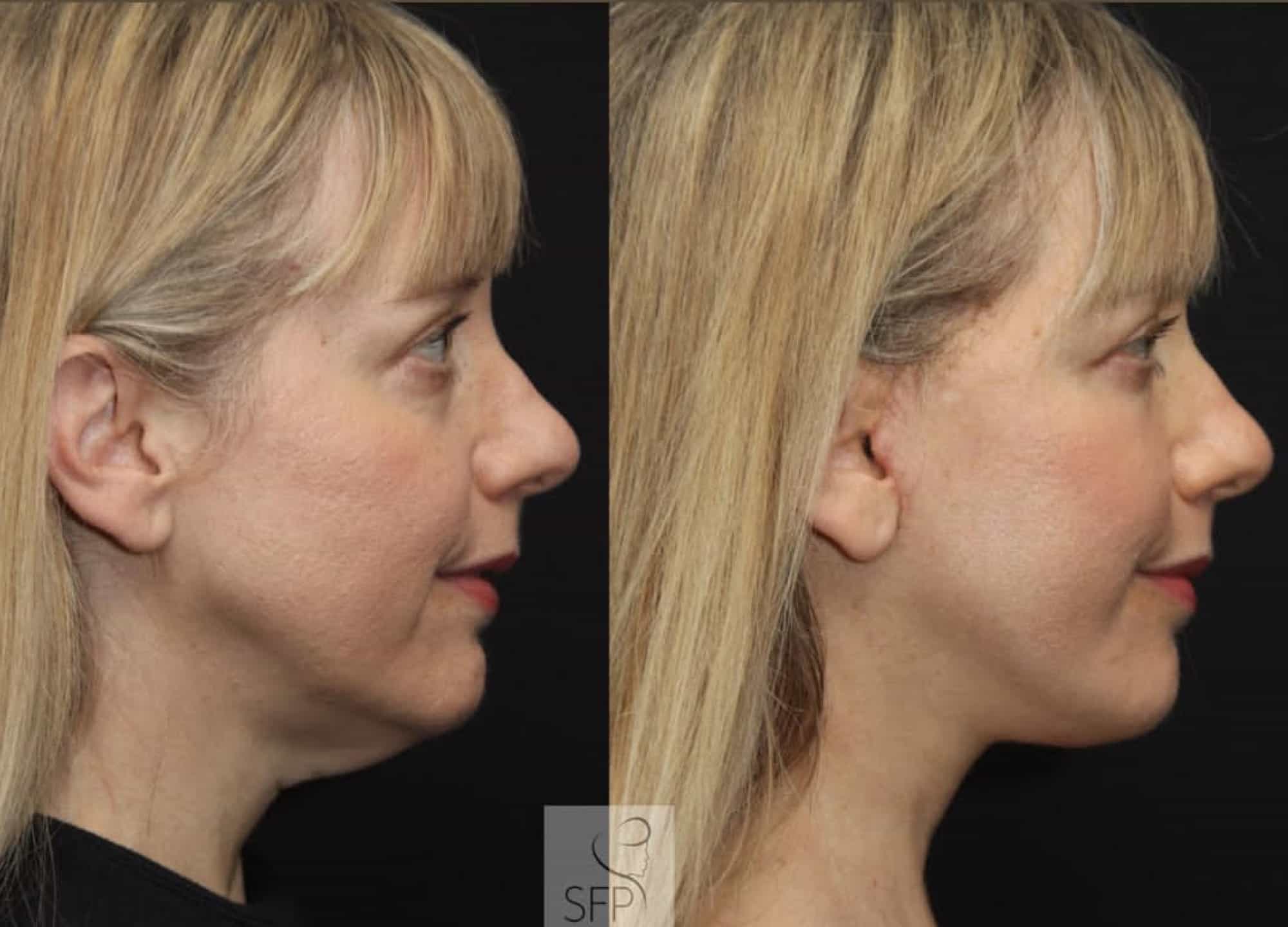 Facelift after cancer