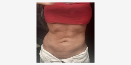 6 Signs of Bad Liposuction and How to Fix Them | RealSelf News