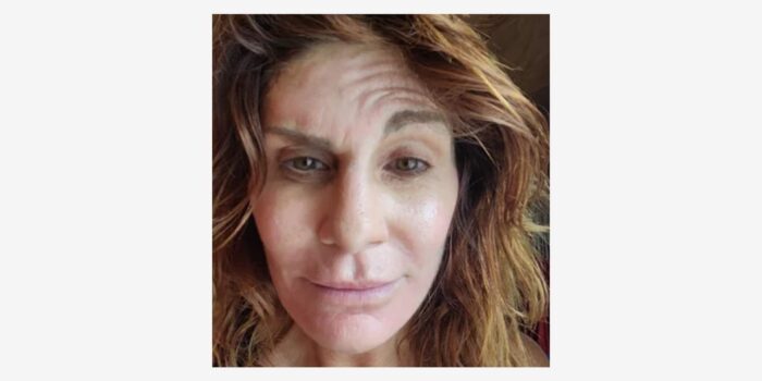 Botched facelift deals