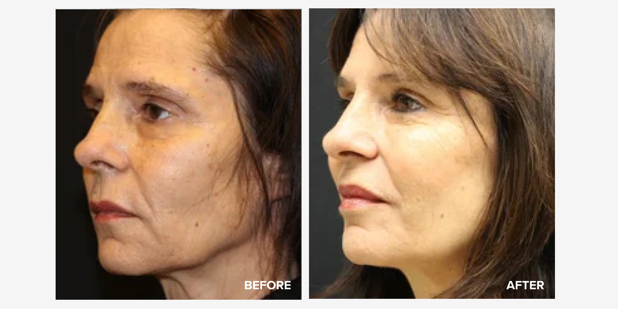 Crystal Flush Com Reviews Before And After 6 Best Sculptra Before and After Photos | RealSelf News