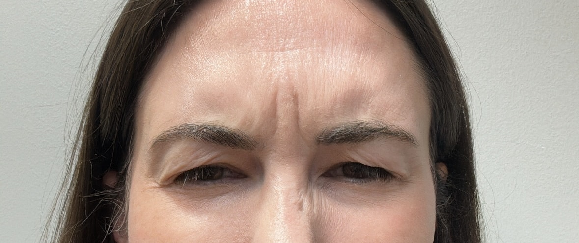 The author, an actual Dysport patient, furrows her brow prior to treatment.