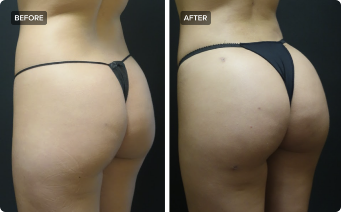 Brazilian butt lift before and after